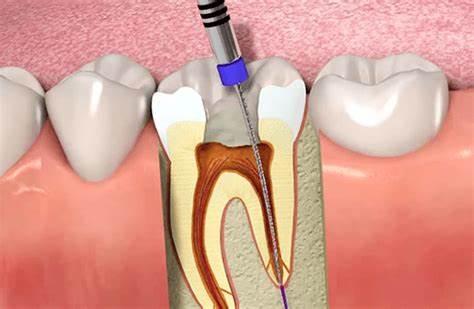 Implants Img