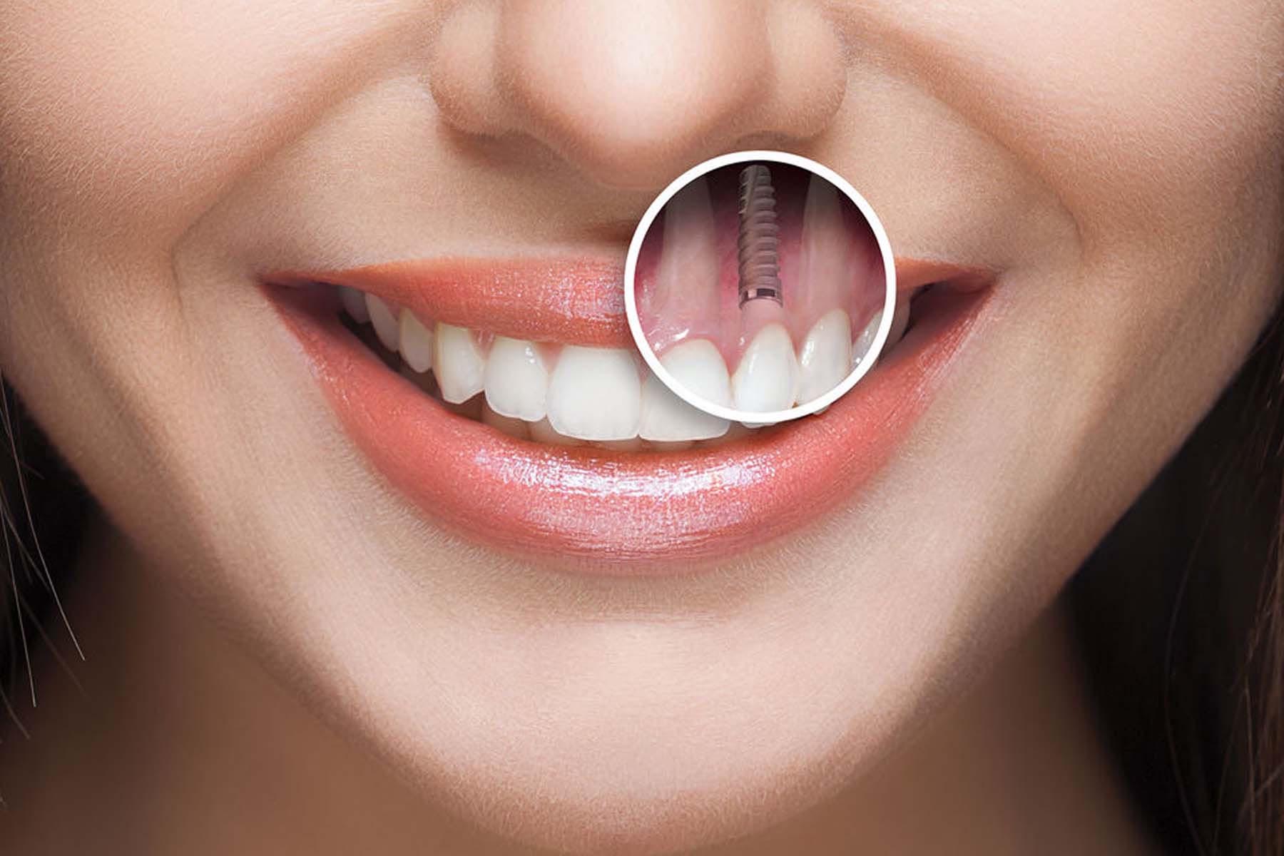 Implants Img