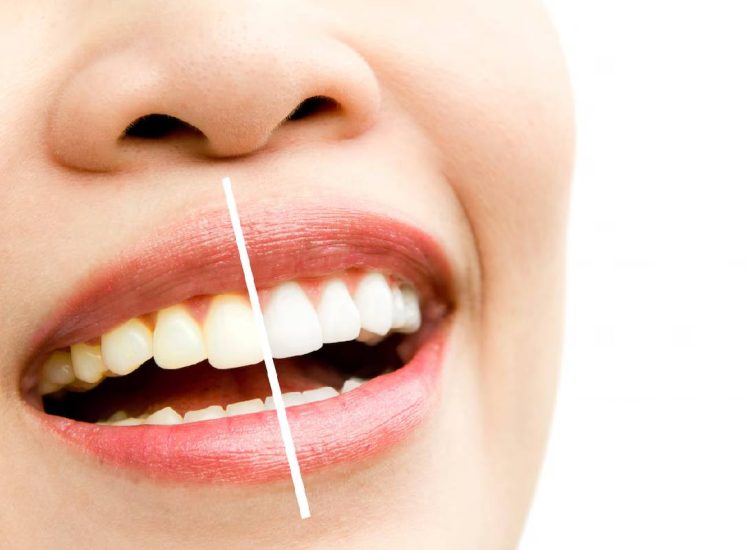 teeth-whitening-banner